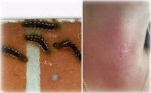 moth larvae on human skin can cause allergic reaction